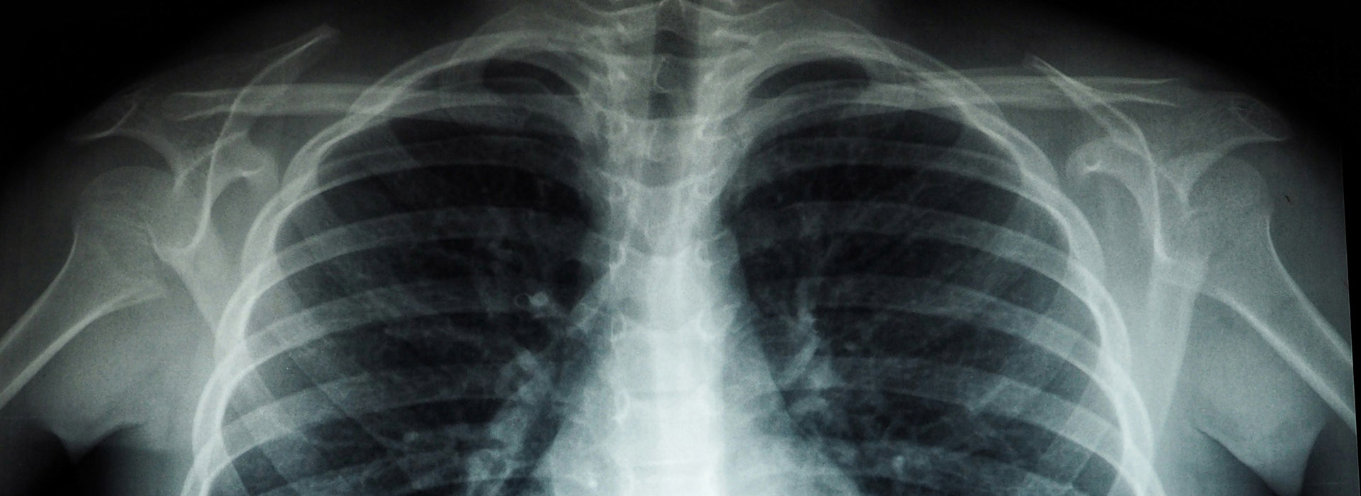 x-ray of a person's chest